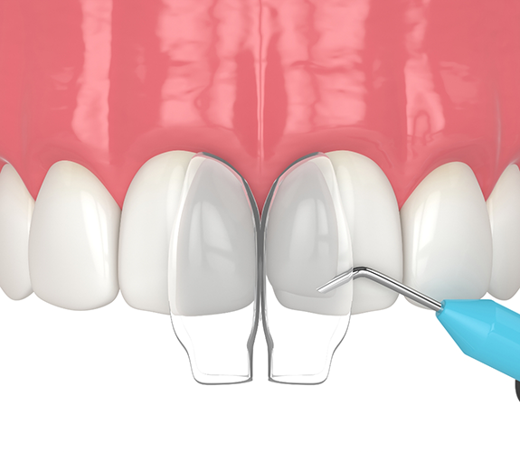 Illustration of cosmetic bonding being performed on upper teeth