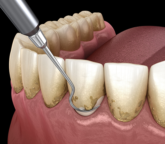 Illustration of scaling and root planing performed on lower teeth