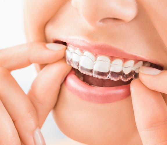 Woman putting clear aligner over upper teeth