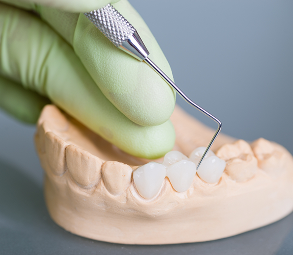 Using dental instrument to examine dental bridge on model of teeth