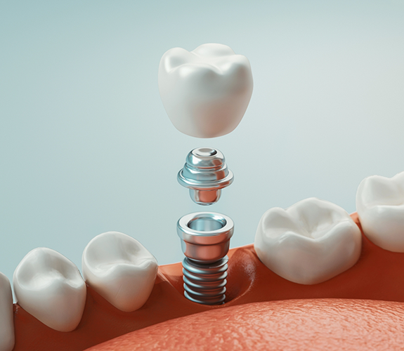 Illustration of crown, abutment, and dental implant being placed