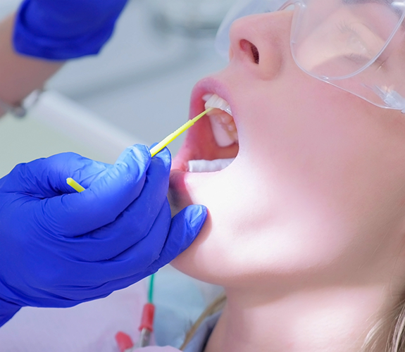 Applying fluoride to child's upper teeth