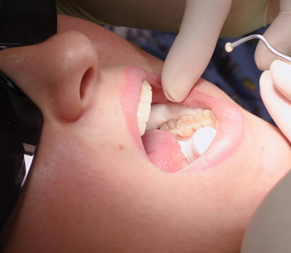 Gloved finger pointing to tooth-colored filling in patient's mouth