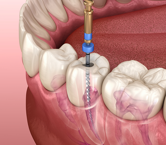 Illustration of root canal treatment in Palm Coast being performed