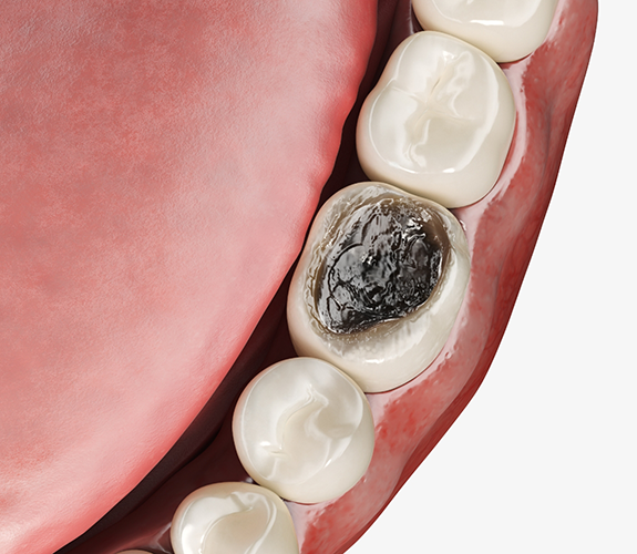 Illustration of badly decayed tooth in jaw